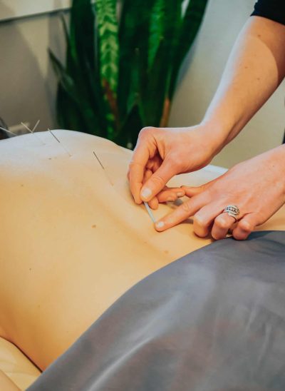 Sports acupuncture on a patient's back, with needles inserted into the skin