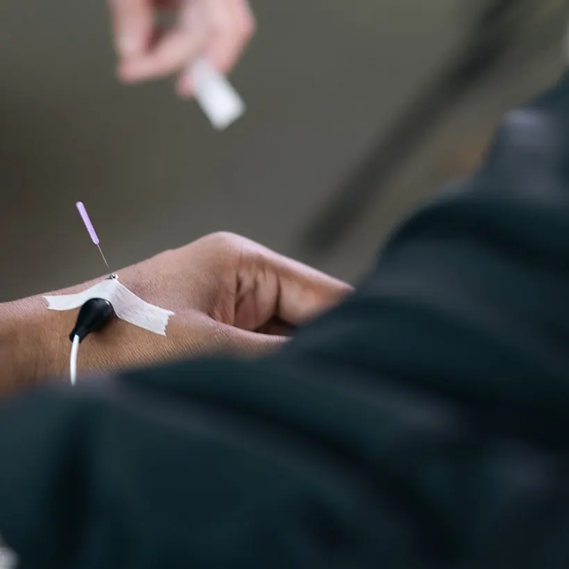 A fine needle with an electroacupuncture lead attached at the wrist