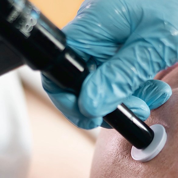 Motorized microneedling treatment at The Zen Point in Bethesda