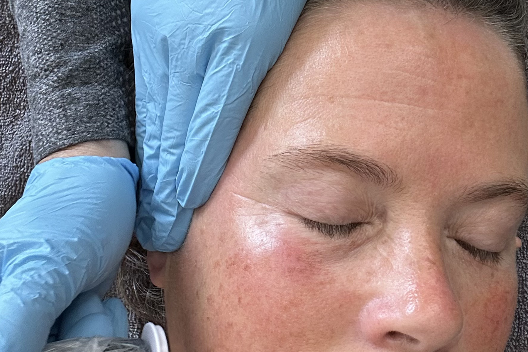 A microneedling facial treatment on the patient's cheek