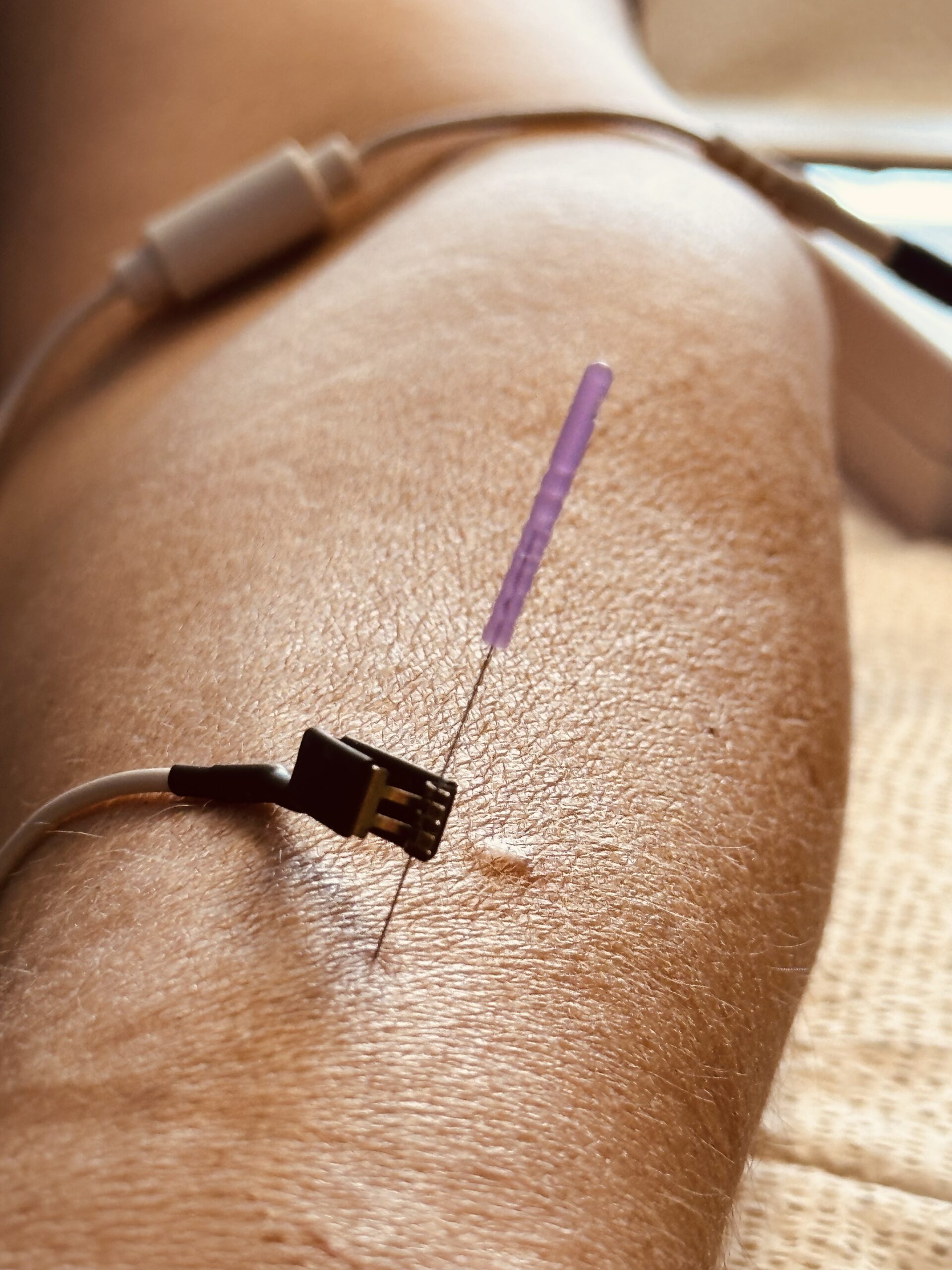 Electroacupuncture medicine treatment featuring a needle connected to an electrode